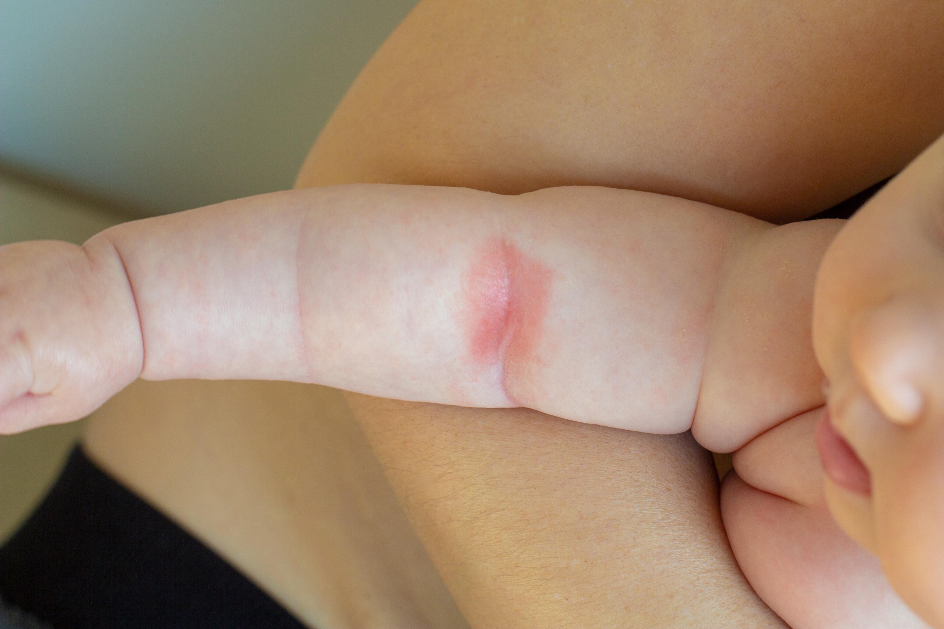 symptômes de l’eczéma infantile